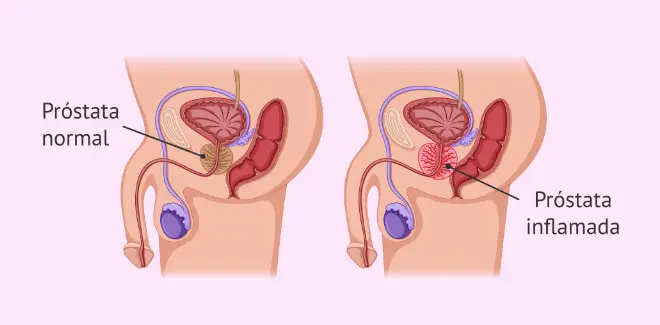 علاج التهاب البروستاتا نهائيا